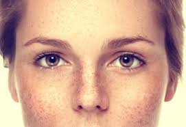 Image result for Freckled skin