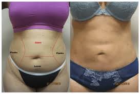 Check spelling or type a new query. Best Laser Lipo Treatment Near Me Lipo 360 Smart Liposuction Liposuction Laser Lipo