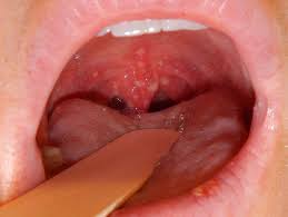 Image result for Hand foot and mouth disease HFMD roof of mouth