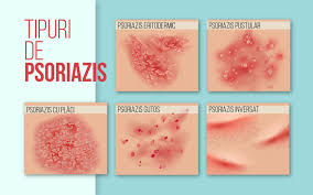 Prevalence and treatment of psoriasis in the united kingdom: Psoriazis Èi Pitiriazis Care E DiferenÈa Cum Se Recunosc Cauze Simptome Tratament Medic Chat