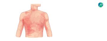 Most cases in the united states are brought in from other countries where typhoid fever is common. Typhoid Fever Symptoms And Treatment Healthsoul