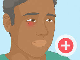 How to Remove a Thorn: 14 Steps (with Pictures)