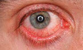 Penyakit mata ikan adalah kondisi dimana terdapat area kulit yang menebal atau keras dan kasar yang umumnya muncul di area anggota tubuh seperti Sakit Mata Merah Bengkak Pedih Adakah Mudah Berjangkit Doctoroncall