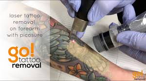 Tattoo removal isn't as easy as getting a tattoo—but it definitely hurts as much. Laser Tattoo Removal On Forearm With Picosure 4k Youtube