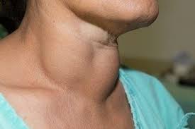 Schilddrusenvergrosserung Struma Ursachen Symptome Diagnose