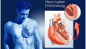 Es können auch grippeähnliche symptome wie. Herzmuskelentzundung Myokarditis Erkennen Und Behandeln