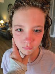 Milkweed pollen causes eye irritation