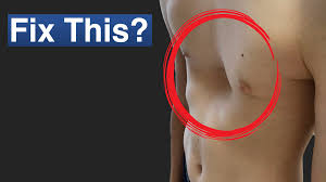 Image result for Pectus Excavatum