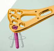 A Comprehensive Guide to Variable Angle Locking Plate ...