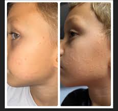 I don't think my previous post has been approved yet. The pediatrician is  saying this isn't new molluscum and he's having an allergic reaction to an  antibiotic. We switched antibiotics and he's