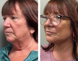 In Canada, what are the prices you are getting for deep plane facelift and  neck? I got a rough estimate of $40,000 for SMAS facelift and neck with a  surgeon in Calgary.