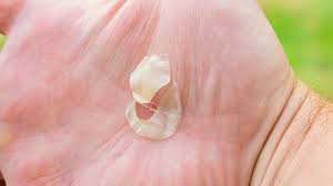 Selepas minum susu kambing nampak perubahan makin baik. 7 Penyebab Kulit Telapak Tangan Mengelupas Dan Cara Atasinya