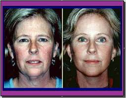 The 52-year-old said she's had her 'life saved'.