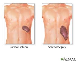 FloridaHealthFinder | Splenomegaly | Health Encyclopedia |  FloridaHealthFinder