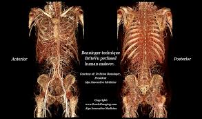The major vessels bringing blood to and from the heart: Britevu Perfused Whole Human Cadaver Britevu
