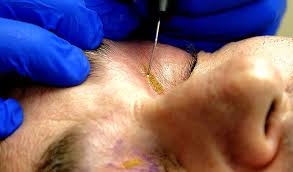 Image result for xantelasma