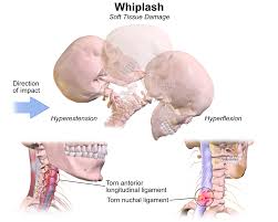 We did not find results for: Whiplash Injury Claims Essential Tips To Maximize Compensation