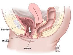 Cystocele Fallen Or Prolapsed Bladder Symptoms Treatment