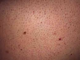 Sac Diplerinde Kirmizi Benek