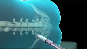 What Happens During Spinal And Epidural Anesthesia Epidural Anesthesiology Anesthesia