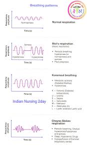 Image result for Cheyne-Stokes Respiration