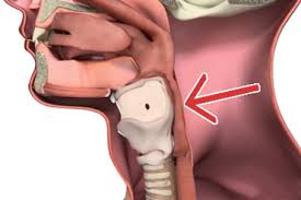 It indicates that cancerous cells have spread from the throat to nearby areas, such as the mouth, lymph nodes and lips. Hypopharyngeal Cancer Treatment Head And Neck Cancer Types Head And Neck Cancer Australia