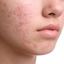 Image result for acne face
