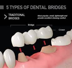 We did not find results for: Types Of Dental Bridges What Type Is Best For Me