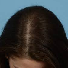 Platelet Rich Plasma In New Jersey Prp Hair Loss Treatment Nj
