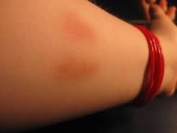 Image result for Snake Bite