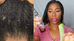 The Best Way To Eliminate Dry Itchy Scalp Flakes Seborrheic Dermatitis Eczema Psoriasi Dry Itchy Scalp Hair Treatment Seborrheic Dermatitis Scalp
