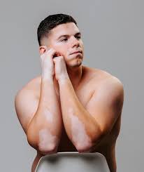 Image result for robert zaruba vitiligo