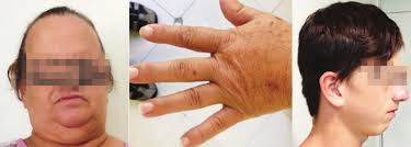 Síndrome de Andersen-Tawil