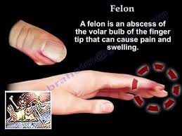 Image result for Felon