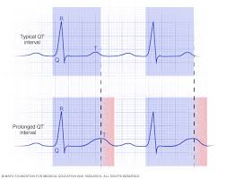 Image result for QT Interval