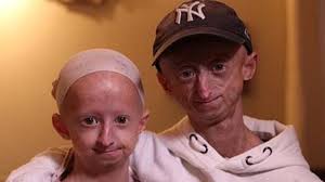 Berns had 'benjamin button' disease called progeria. Belgium Brother Sister Battle Incredibly Rare Benjamin Button Disease Al Bawaba