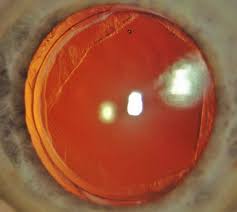 Der Graue Star Katarakt Nachstar