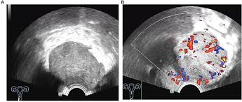 We did not find results for: Frontiers Diagnosis Of Deep Infiltrating Endometriosis Using Transvaginal Ultrasonography Medicine