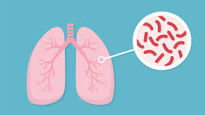 Tuberculosis is curable and preventable. Tuberculosis Nursing Ce Course Nursingce