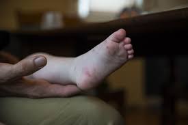 Hand Foot And Mouth Disease Symptoms Causes And Treatment