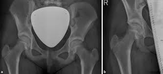 The anterior inferior iliac spine (abbreviated: Avulsionsverletzungen Der Huftregion Des Jugendlichen Springerlink