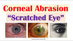 Corneal Abrasion (“Scratched Eye”) | Causes, Signs & Symptoms, Diagnosis,  Treatment - Youtube