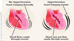Image result for Hypertension