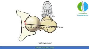 Image result for Femoral Retroversion