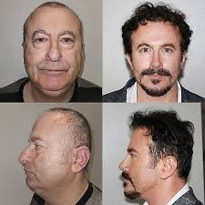 turkish surgeon completely transforms this man's face after performing a  facelift, necklift, lower eyelid blepharoplasty, upper blepharoplasty,  buccal fat removal, rhinoplasty, and hair transplant procedures
