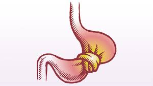 Gastric bypass, lap band and gastric sleeve help. Bariatric Surgery Patients See Weight Gain After Honeymoon Peri