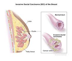 Image result for Inflammatory breast cancer