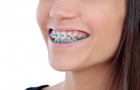This could be an early warning sign that a cavity is developing. Orthodontics Braces How To Prevent Cavities With Braces