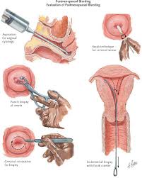 Image result for Postmenopausal Bleeding