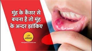 .gale me cancer ki ganth ki pehchan gums disease symptoms & treatment how to cure tongue cancer how to get rid of mouth cancer how to treat ki dawa masudo me sujan ki medicine mauth cansar minor salivary gland carcinomas mouth cancer mouth cancer hindi mouth cancer in hindi. à¤® à¤¹ à¤• à¤• à¤¸à¤° à¤¸ à¤¬à¤šà¤¨ à¤¹ à¤¤ à¤® à¤¹ à¤® à¤ à¤• à¤